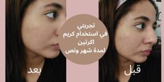 تجربتي مع كريم اكرتين للمسام الواسعة