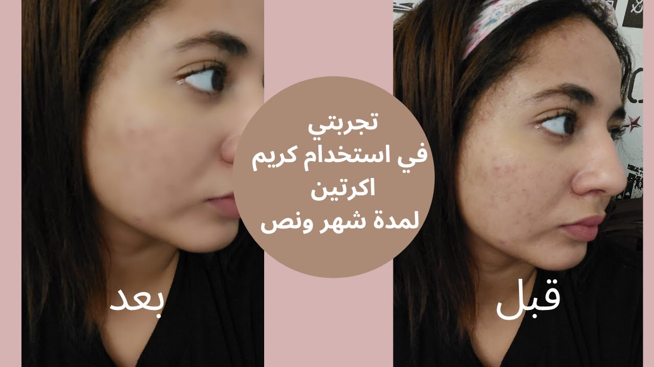 تجربتي مع كريم اكرتين للمسام الواسعة