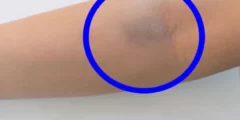 أسباب ظهور بقع زرقاء على جسم المرأة بدون سبب أسباب ظهور بقع زرقاء على جسم المرأة بدون سبب