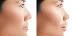كم سعر عملية تجميل الأنف في تركيا