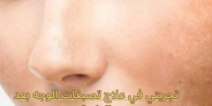 تجربتي في علاج تصبغات الوجه بعد الولادة