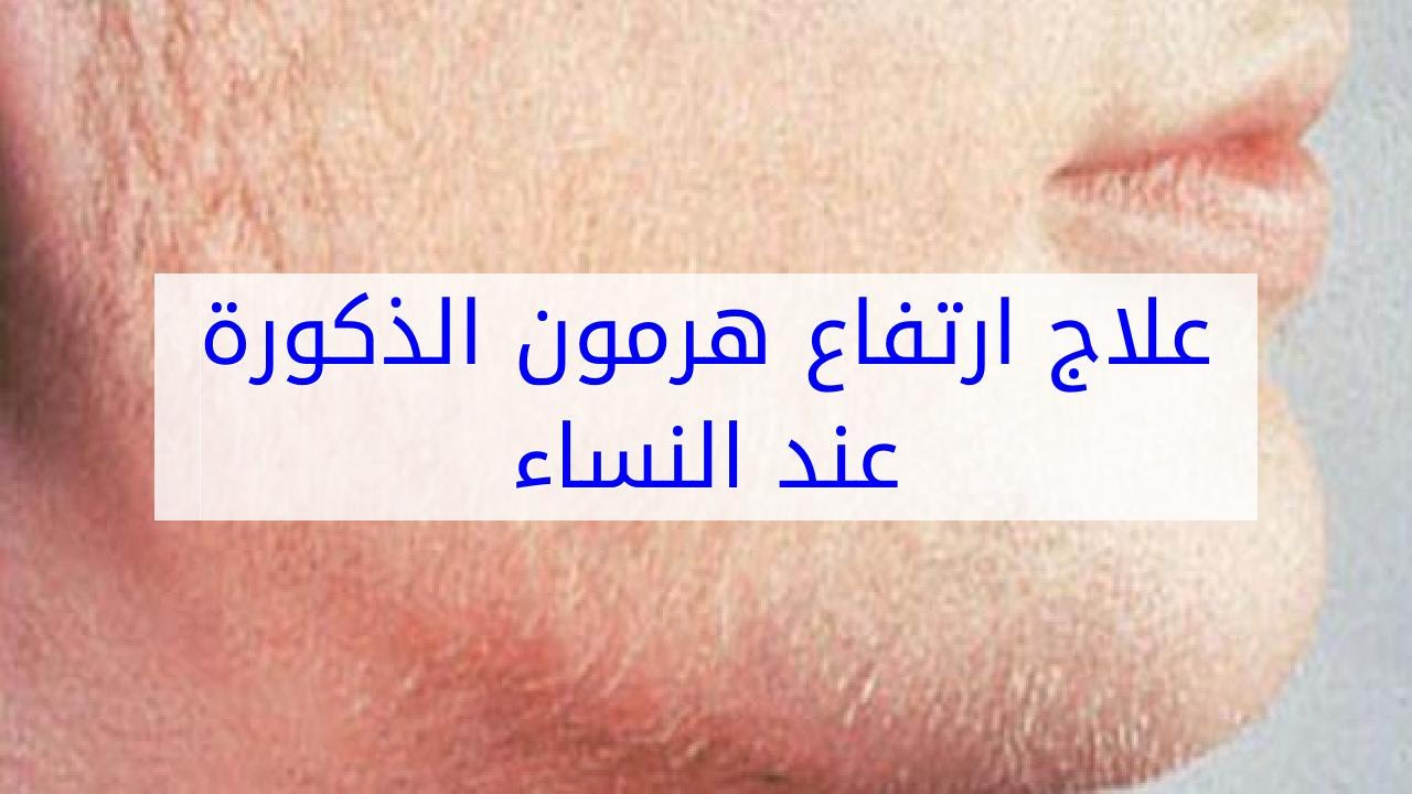 تجربتي في علاج هرمون الذكورة عند النساء للحمل