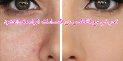 تجربتي مع التخلص من المسامات الواسعه بالخدود