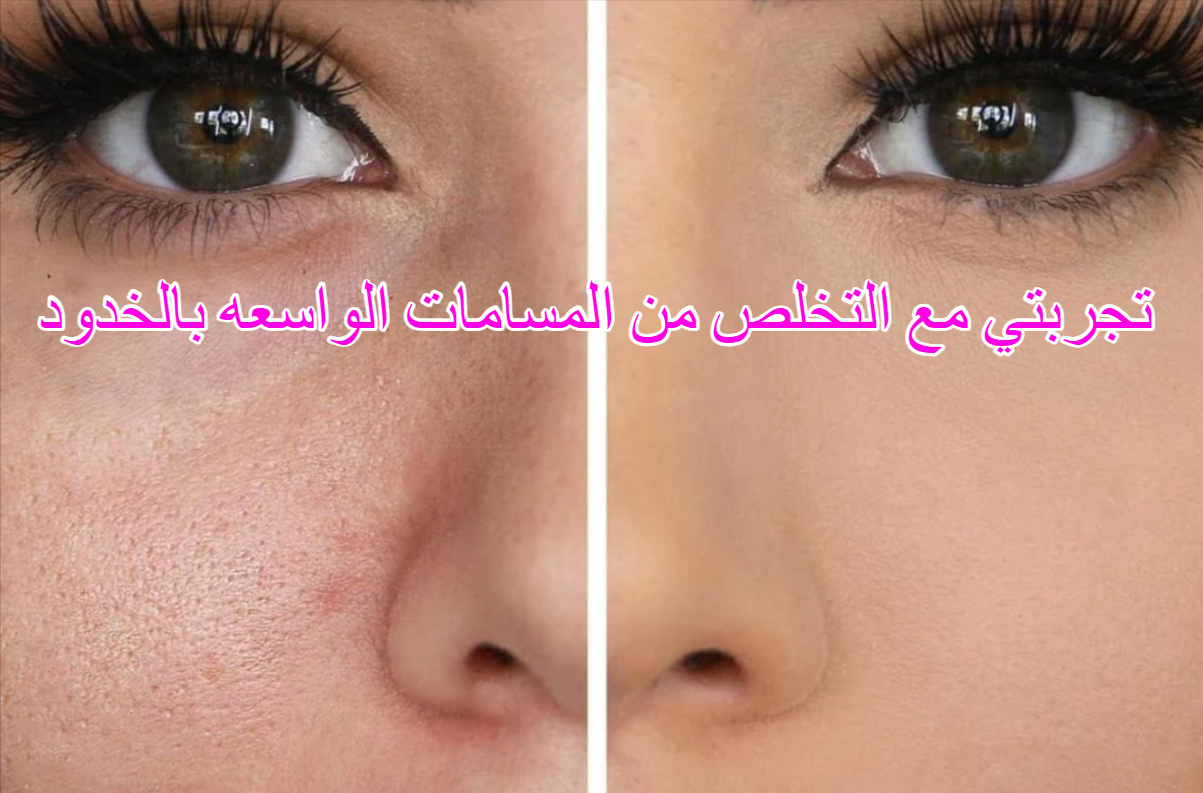 تجربتي مع التخلص من المسامات الواسعه بالخدود
