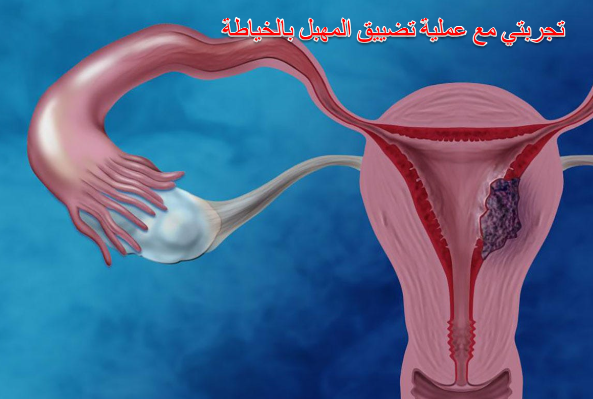 تجربتي مع عملية تضييق المهبل بالخياطة