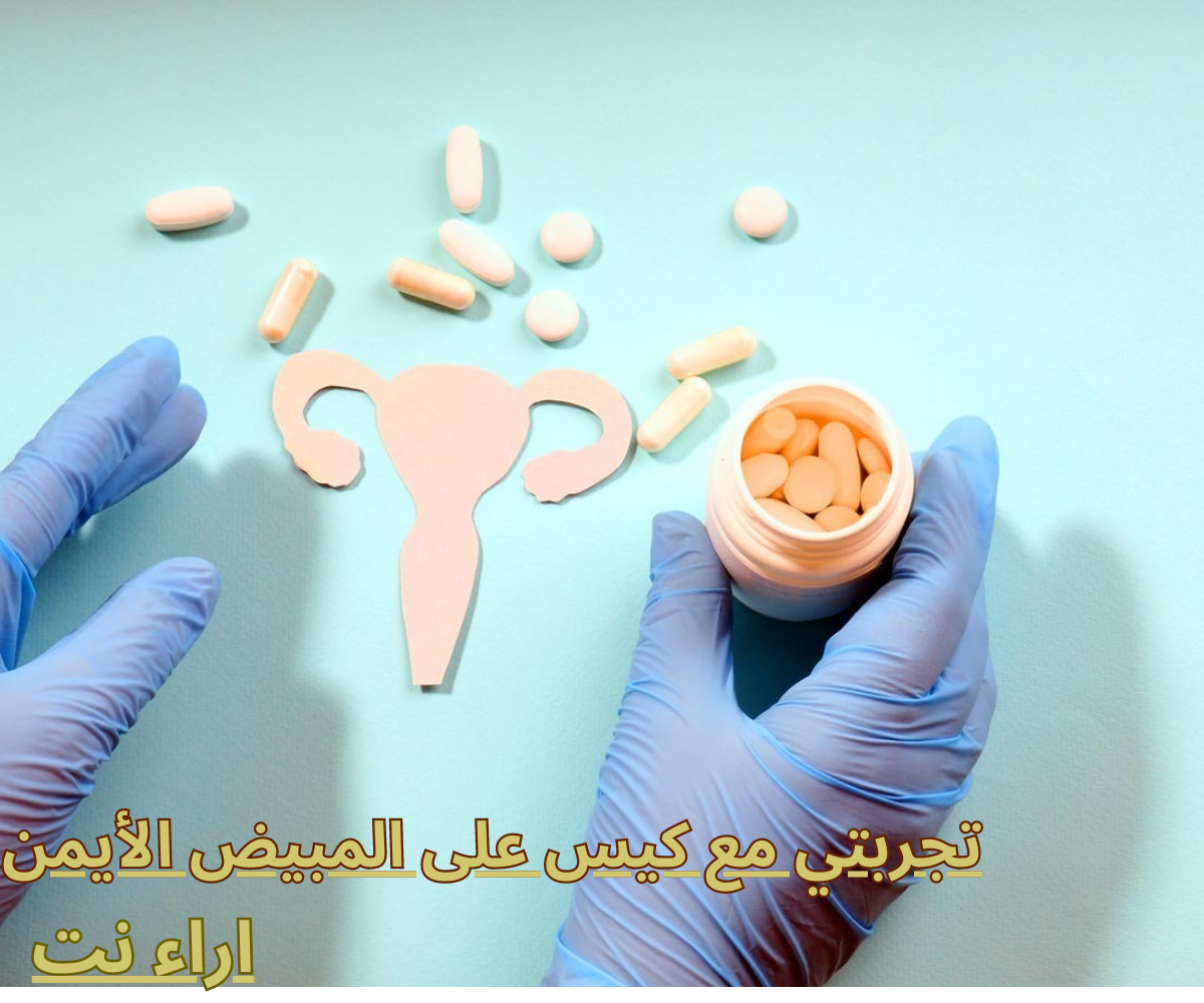 تجربتي مع كيس على المبيض الأيمن