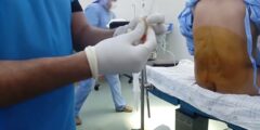 تجربتي مع الخزعة الظهر