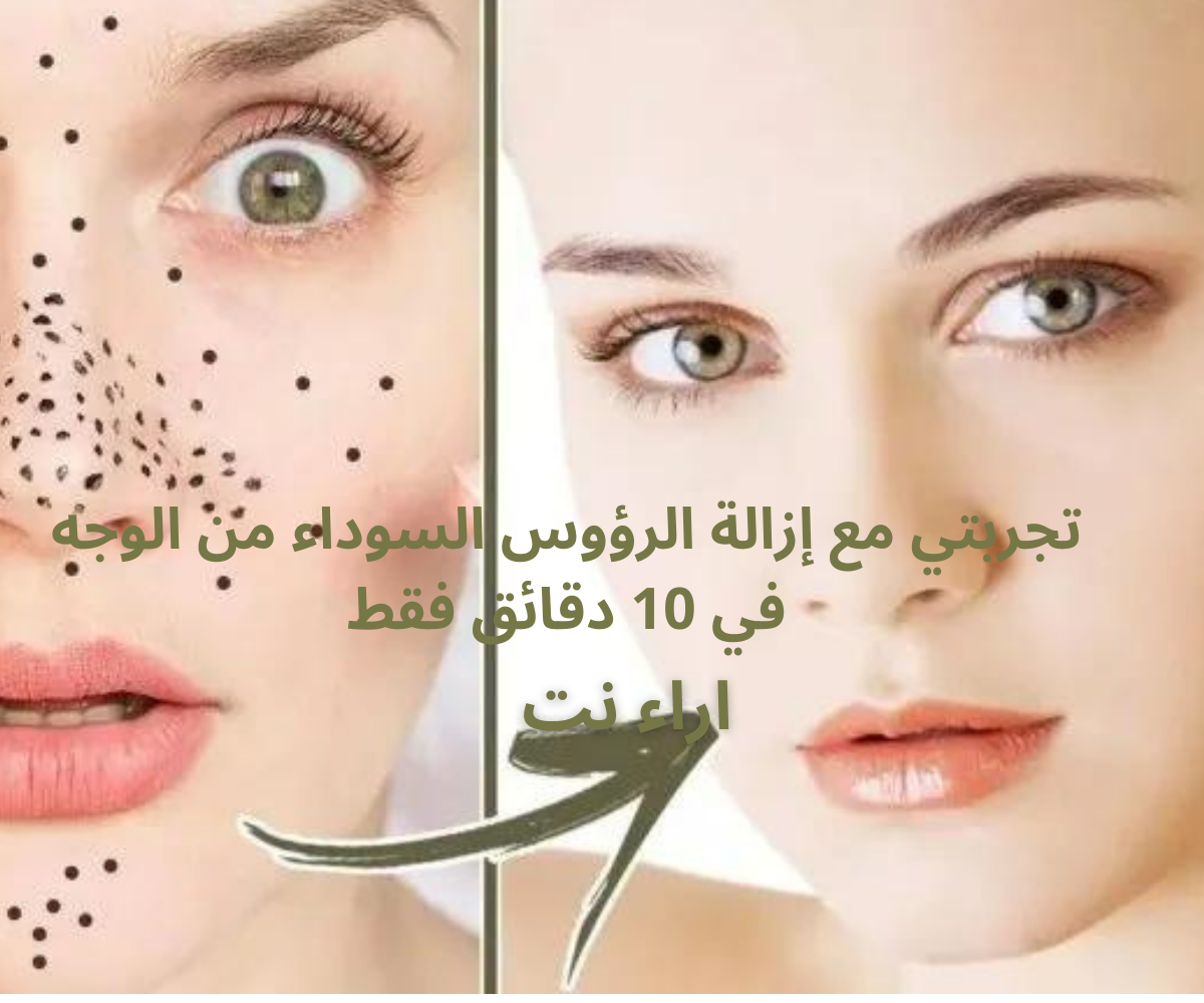 تجربتي مع إزالة الرؤوس السوداء من الوجه في 10 دقائق فقط