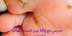 تجربتي مع إزالة عين السمكة نهائيا