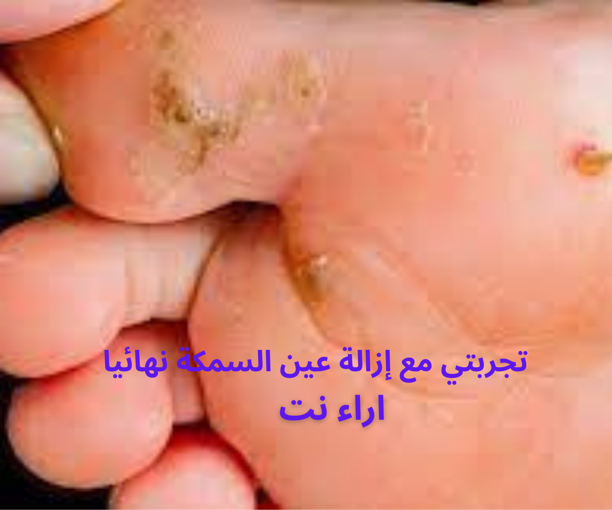 تجربتي مع إزالة عين السمكة نهائيا