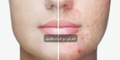 تجربتي مع ايزوتريتينوين جل للبشرة