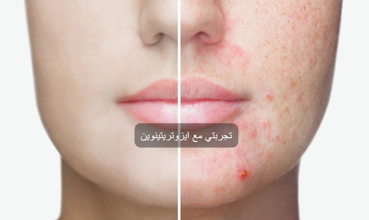 تجربتي مع ايزوتريتينوين جل للبشرة