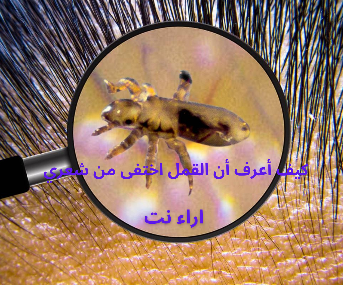 كيف أعرف أن القمل اختفى من شعري