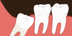 كيف توقف الم الضرس المثقوب